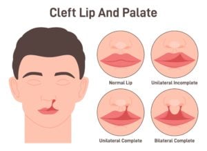 cleft lip facial surgery chandler arizona